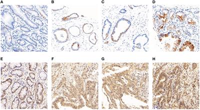 The association and clinicopathological significance of Integrin alphavbeta6 and Rac1 expression in gastric carcinoma